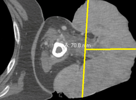 FUNGATING SARCOMA 