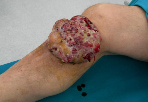GIANT EXOPHYTIC LEIOMYOSARCOMA 