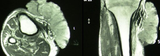 GIANT EXOPHYTIC LEIOMYOSARCOMA 
