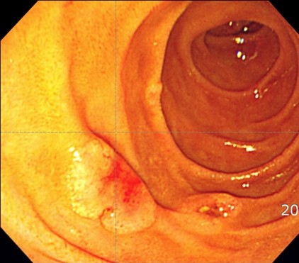 GRANULOCYTIC SARCOMA - DUODENUM
