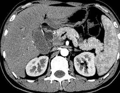 GRANULOCYTIC SARCOMA - PANCREAS