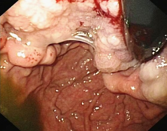 GRANULOCYTIC SARCOMA - STOMACH
