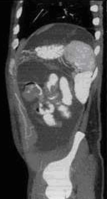 GRANULOCYTIC SARCOMA OF SMALL BOWEL - PERITONEUM - MESENTERY