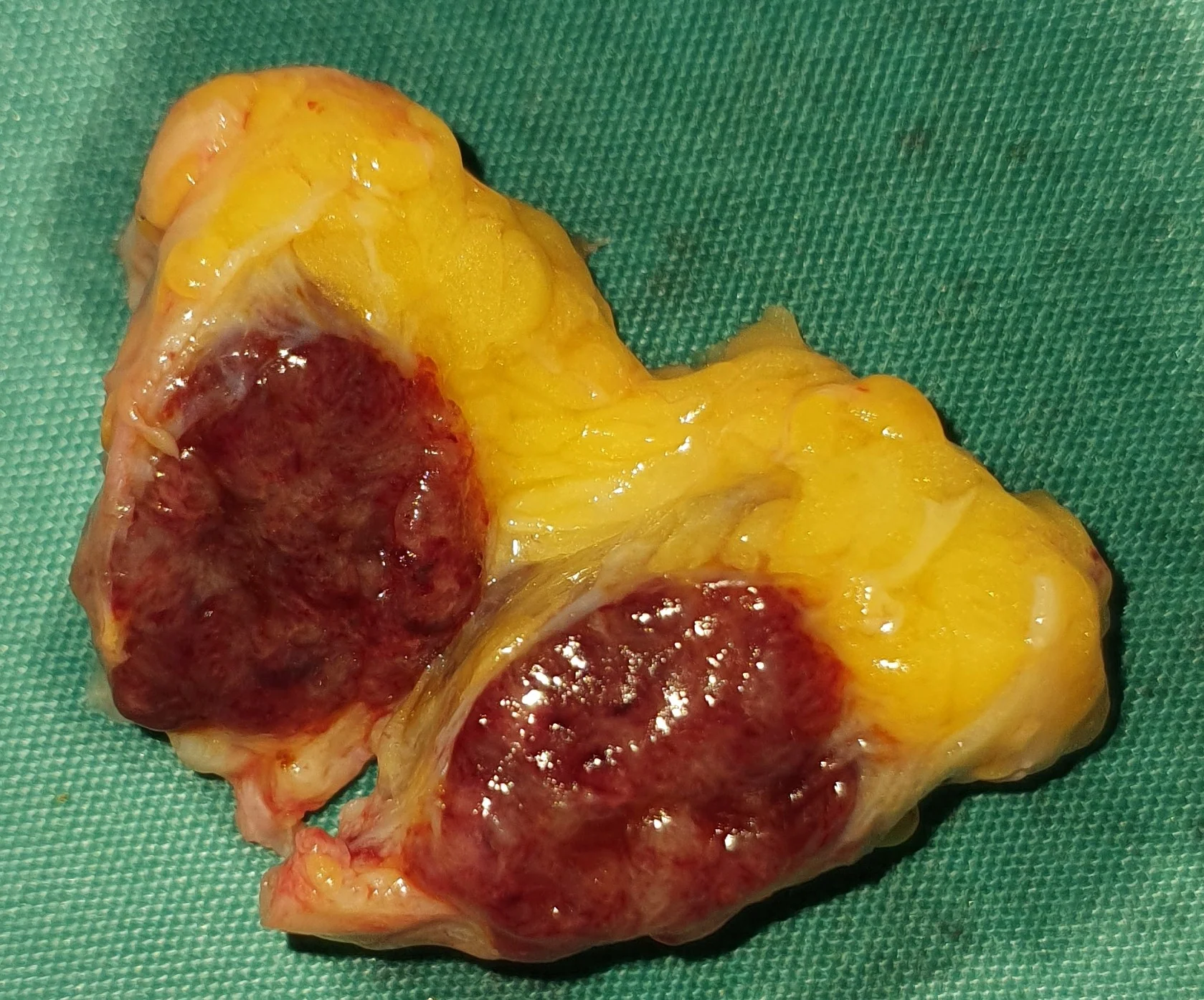 KAPOSI SARCOMA