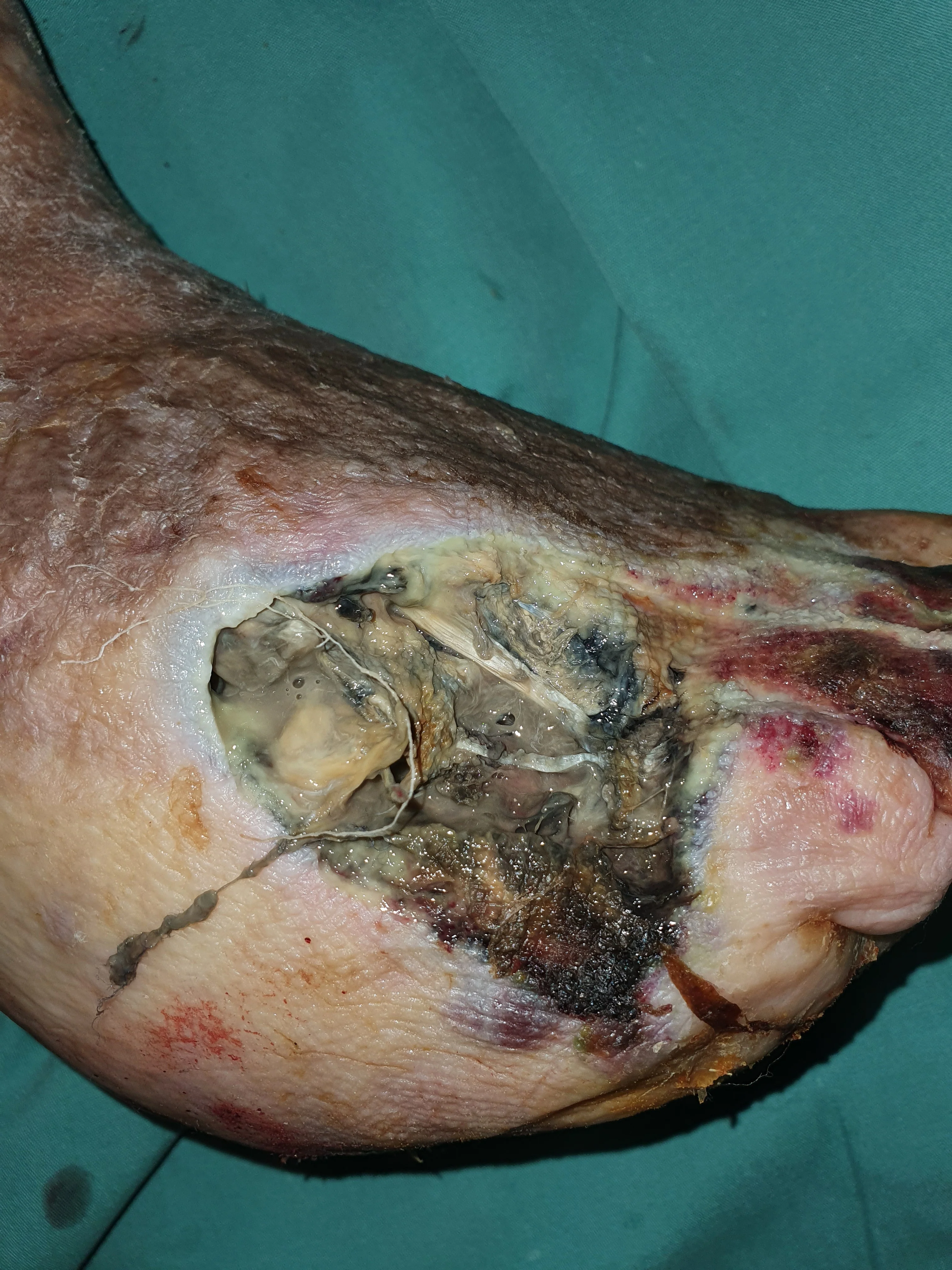 KAPOSI SARCOMA + GANGRENE