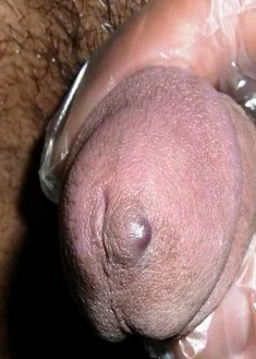 PENILE KAPOSI SARCOMA