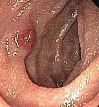 KAPOSI'S SARCOMA DUODENUM