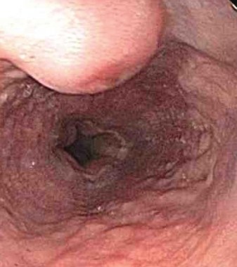 ESOPHAGEAL KAPOSI'S SARCOMA 