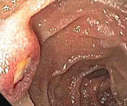 JEJUNAL KAPOSI'S SARCOMA