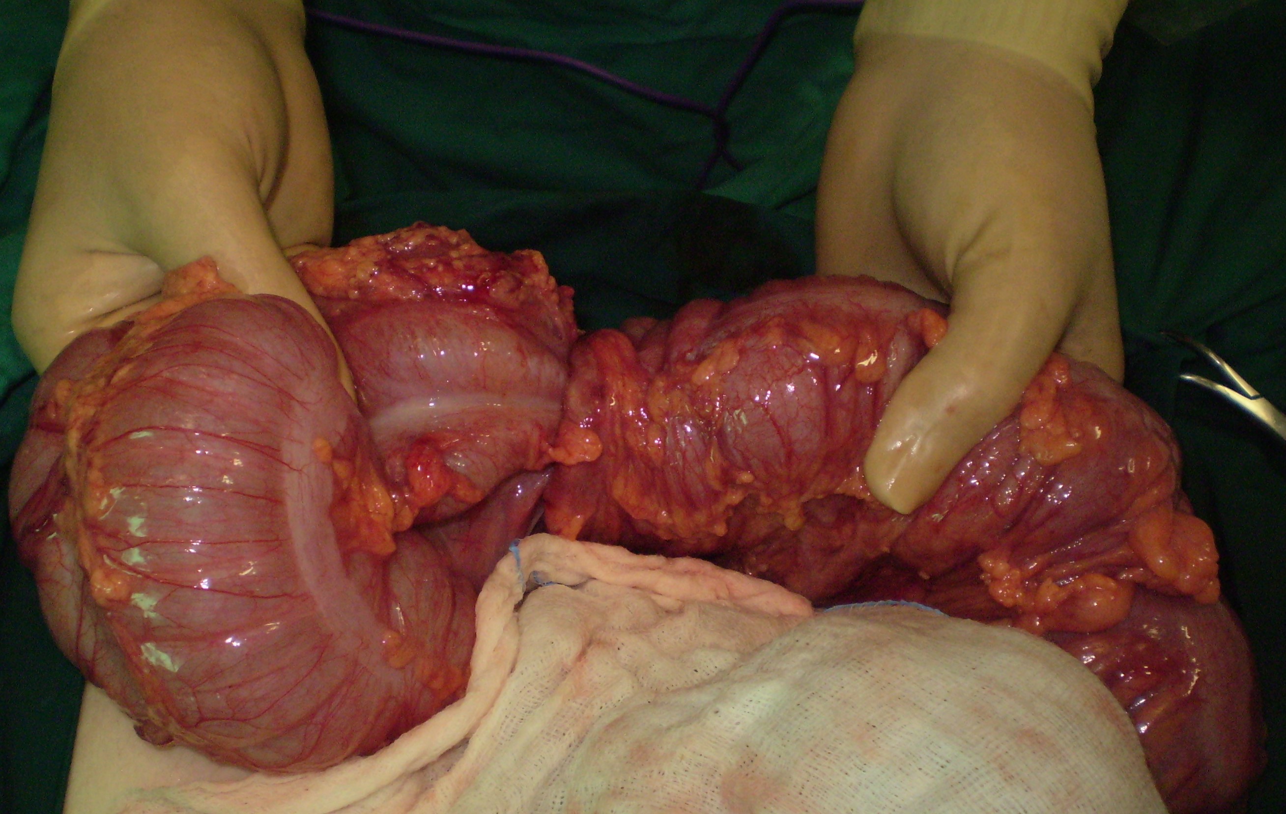 COLO-COLONIC INTUSSUSCEPTION - SARCOMA
