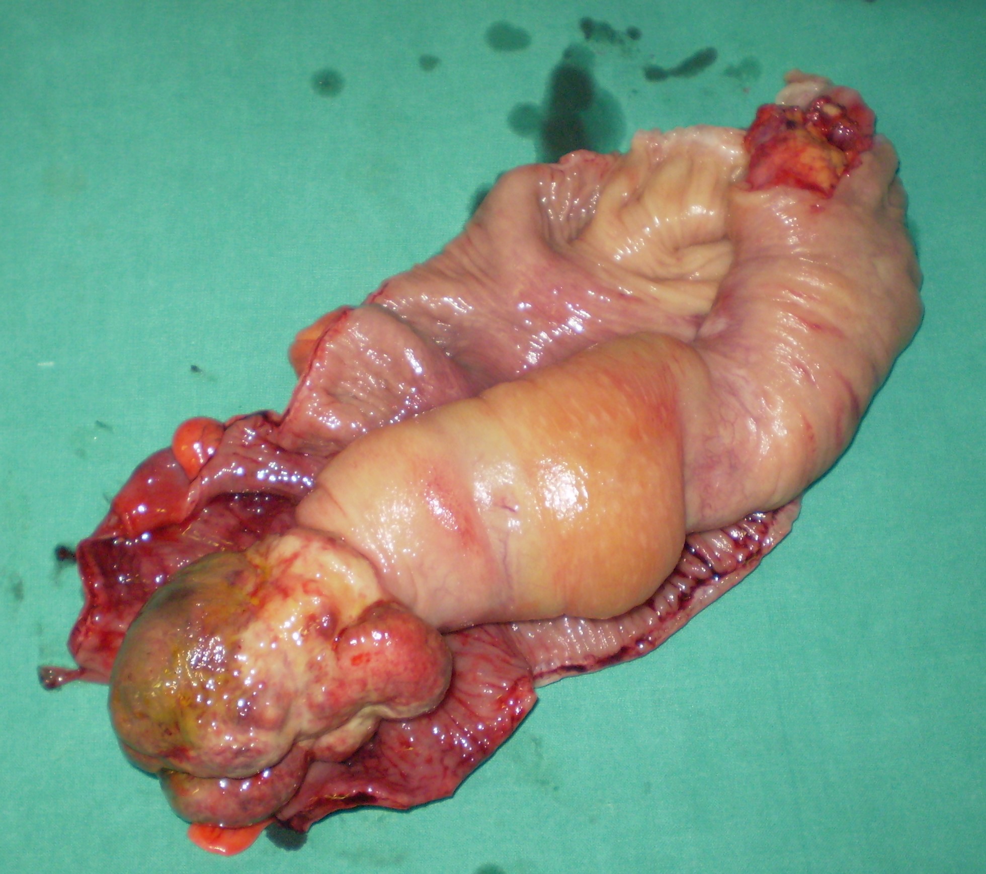 COLONIC LEIOMYOSARCOMA
