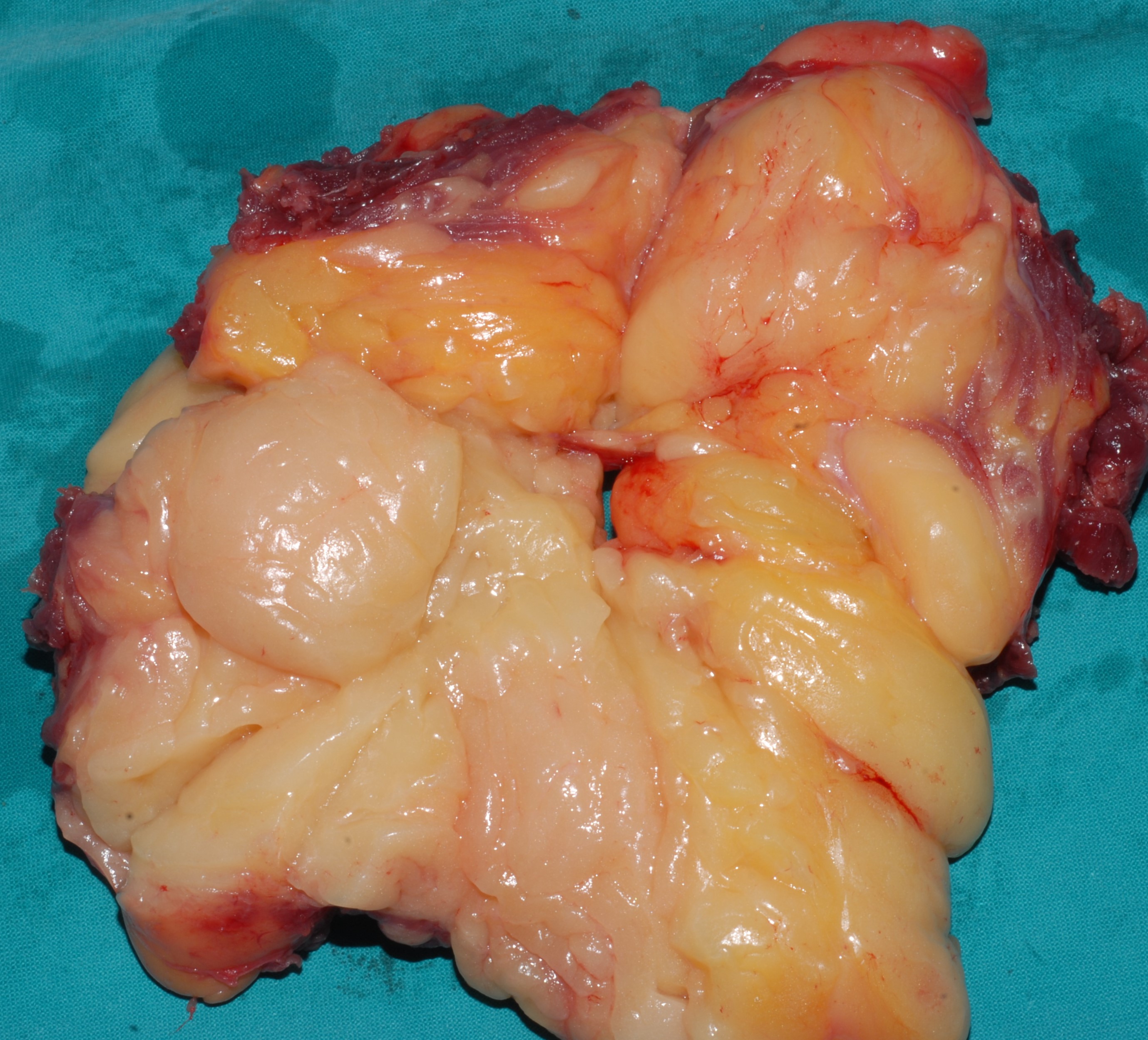 LIPOSARCOMA