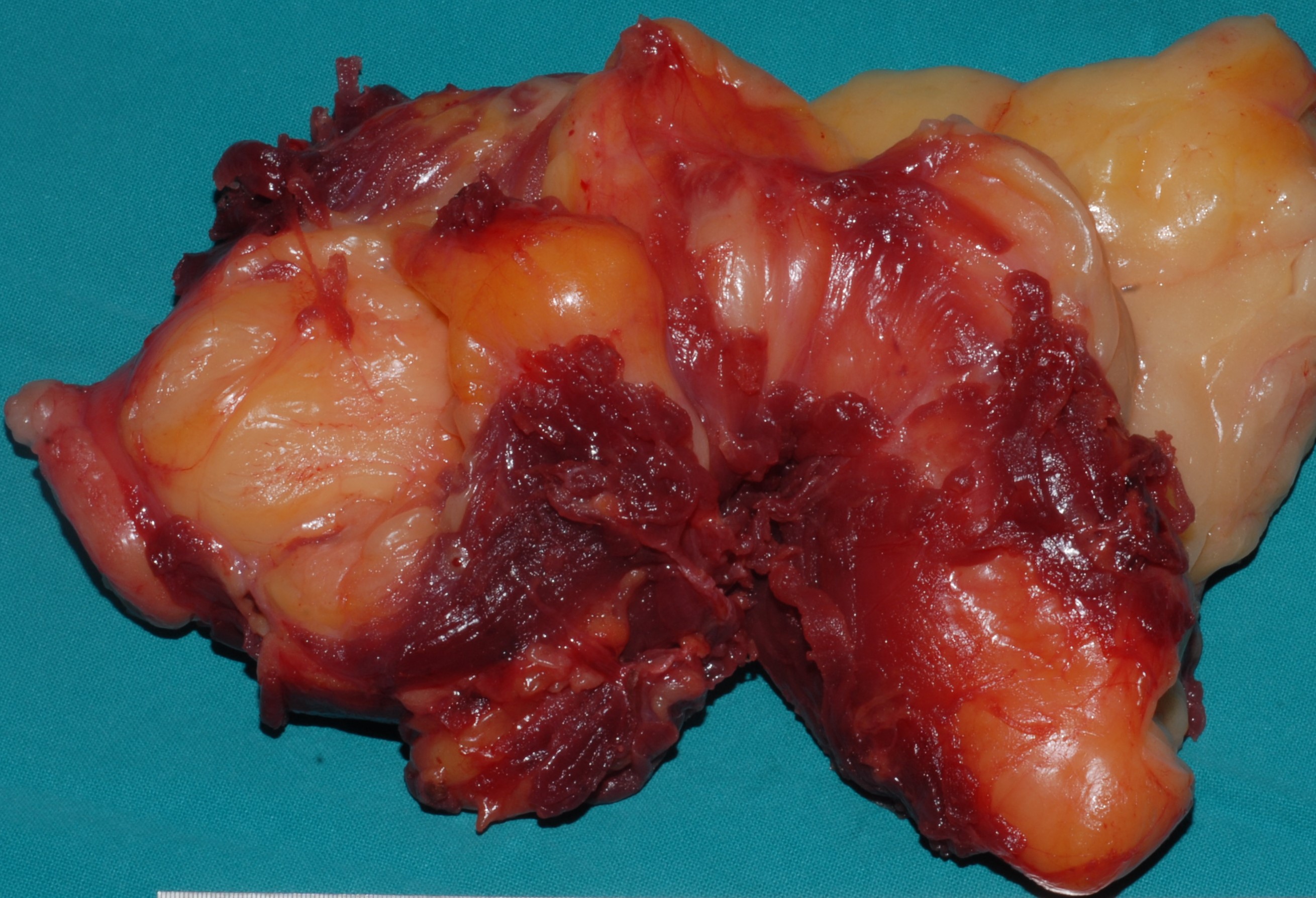 LIPOSARCOMA