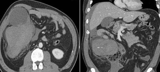 LIPOSARCOMA ASCENDING COLON