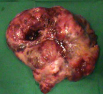 LUMPAR LIPOSARCOMA