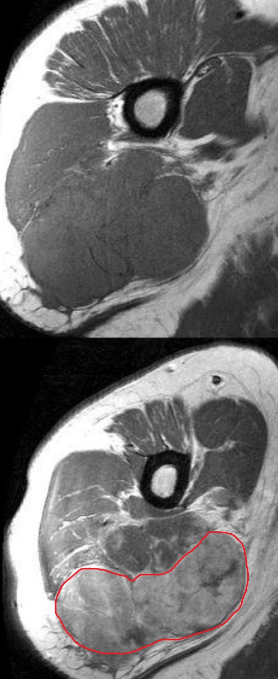 AXILLARY LIPOSARCOMA
