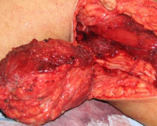 AXILLARY LIPOSARCOMA