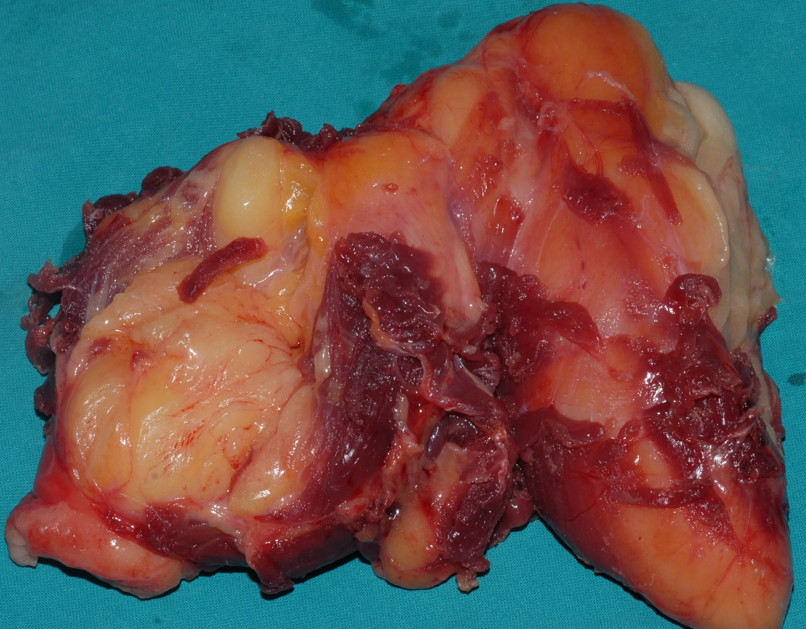SCAPULAR LIPOSARCOMA