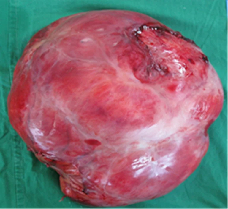 ABDOMINAL LIPOSARCOMA