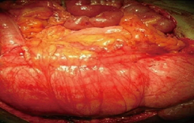 MULTIPLE ABDOMINAL LIPOSARCOMAS