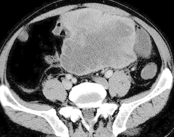 MULTIPLE ABDOMIKAL LIPOSARCOMAS