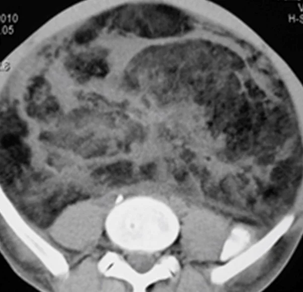MULTIPLE ABDOMINAL LIPOSARCOMAS