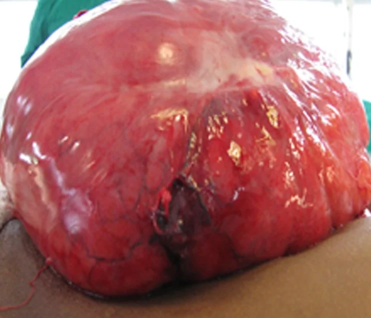 ABDOMINAL LIPOSARCOMAS