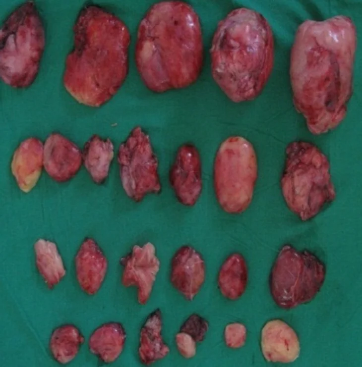 MULTIPLE ABDOMIKAL LIPOSARCOMAS