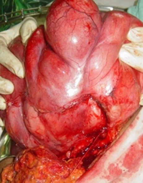 MULTIPLE ABDOMINAL LIPOSARCOMAS
