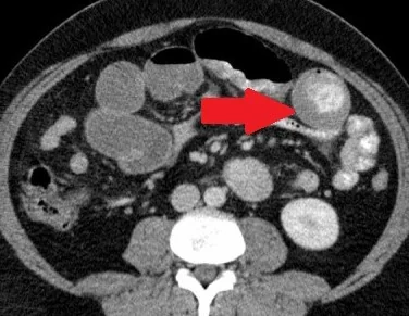 MYELOID-GRANULOCYTIC SARCOMA - BOWEL