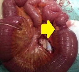 MYELOID-GRANULOCYTIC SARCOMA - BOWEL