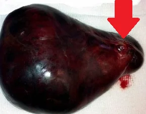 MYXOID LIPOSARCOMA
