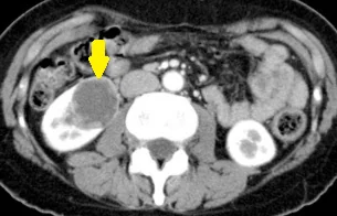 RENAL PEComa