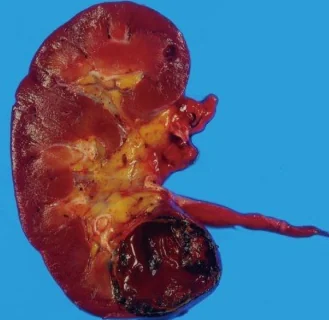 RENAL PEComa