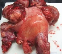 ABDOMINAL PEComa