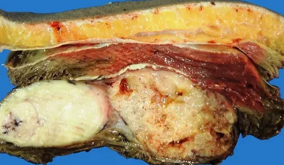 PLEOMORPHIC RHABDOMYOSARCOMA