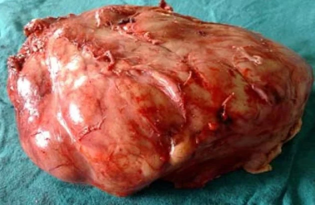 RETROPERITONEAL LIPOSARCOMA