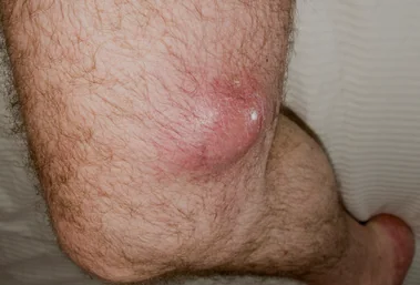 SARCOMA