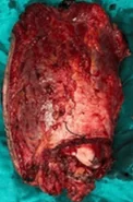 THIGH SARCOMA