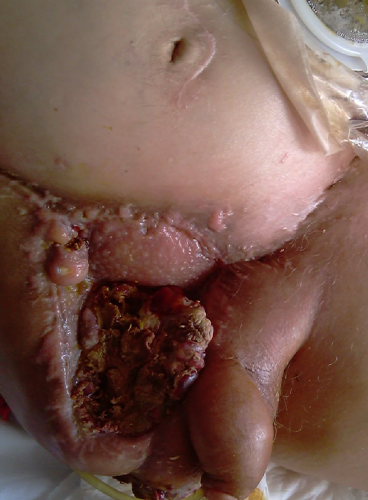 RECURRENT SARCOMA