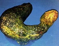 GASTRIC SHAPED TRICHOBEZOAR