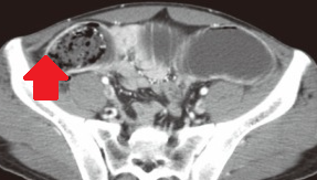 INTESTINAL BEZOAR