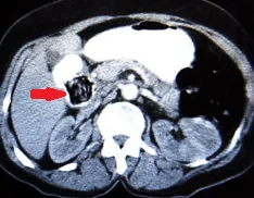 DUODENAL BEZOAR