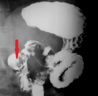 BARIUM STUDY - DUODENAL BEZOAR