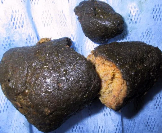 GASTRIC BEZOAR