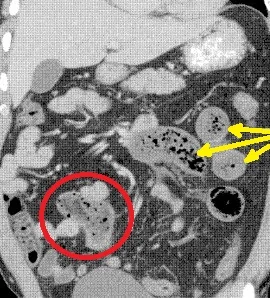 BEZOAR IN MECKEL'S DIVERTICULUM