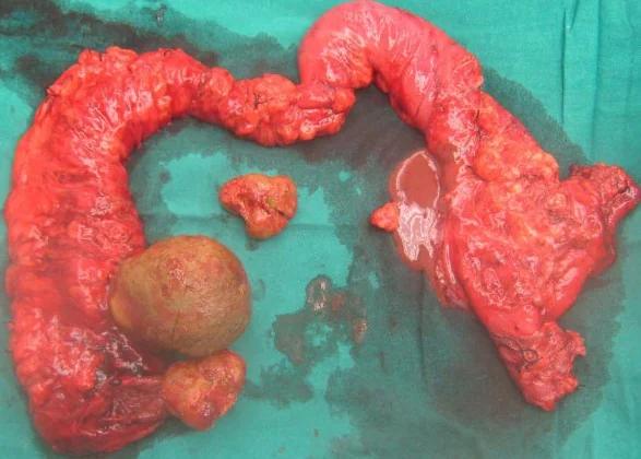 COLONIC BEZOARS