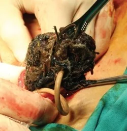 FEEDING TUBE BEZOAR