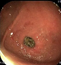 DUODENAL BEZOAR - PYLORIC OBSTRUCTION