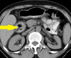 DUODENAL DIVERTICULUM WITH BEZOAR